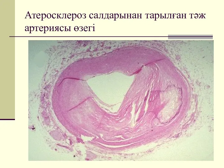 Атеросклероз салдарынан тарылған тәж артериясы өзегі