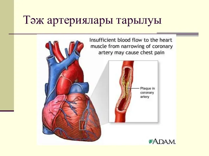 Тәж артериялары тарылуы