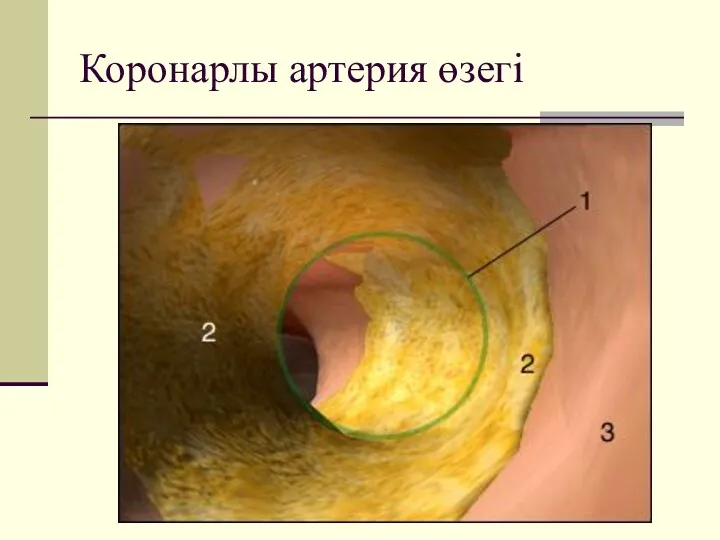 Коронарлы артерия өзегі