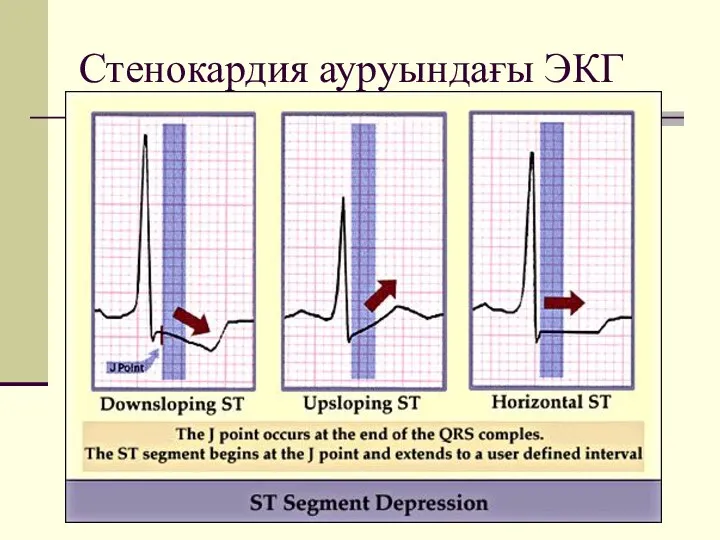 Стенокардия ауруындағы ЭКГ