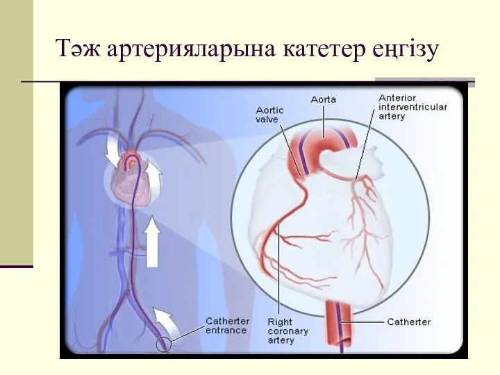 Тәж артерияларына катетер еңгізу