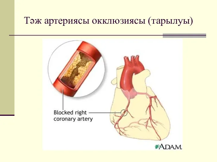 Тәж артериясы окклюзиясы (тарылуы)