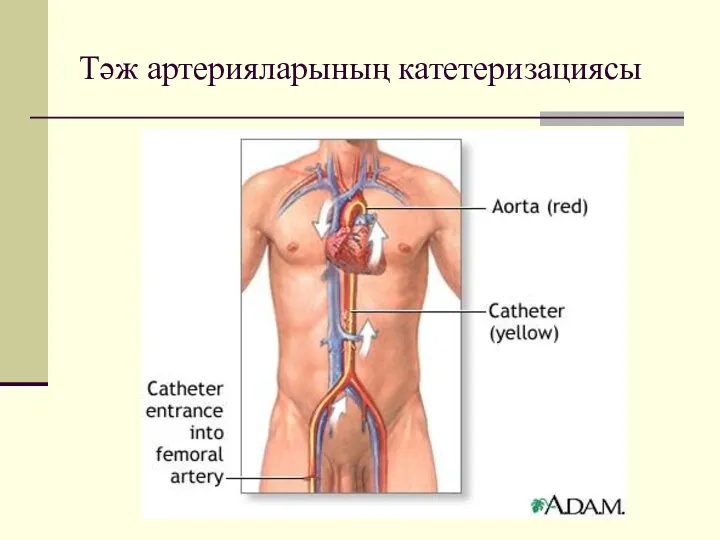 Тәж артерияларының катетеризациясы