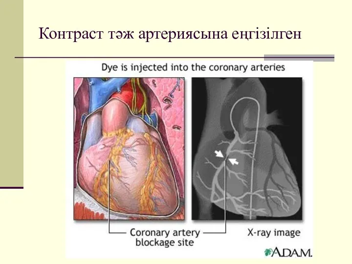 Контраст тәж артериясына еңгізілген