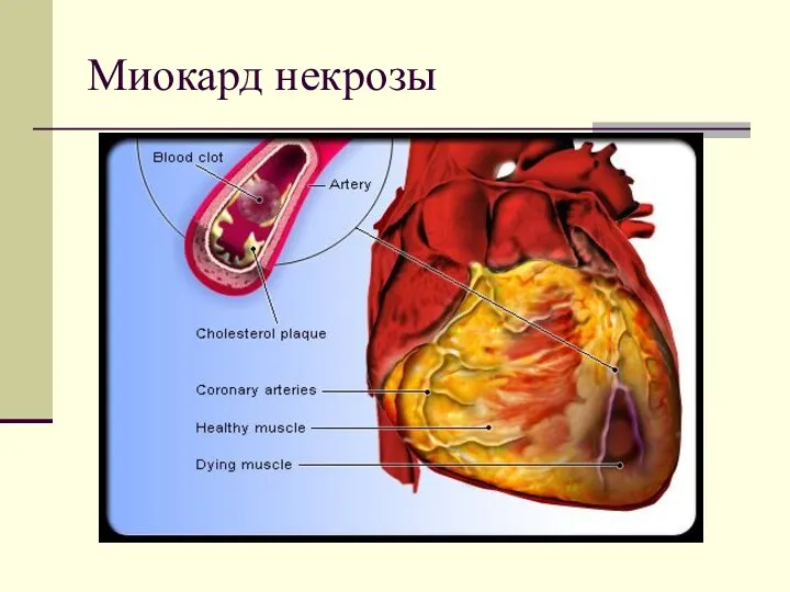 Миокард некрозы