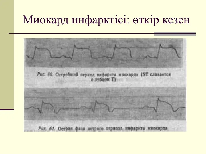 Миокард инфарктісі: өткір кезен