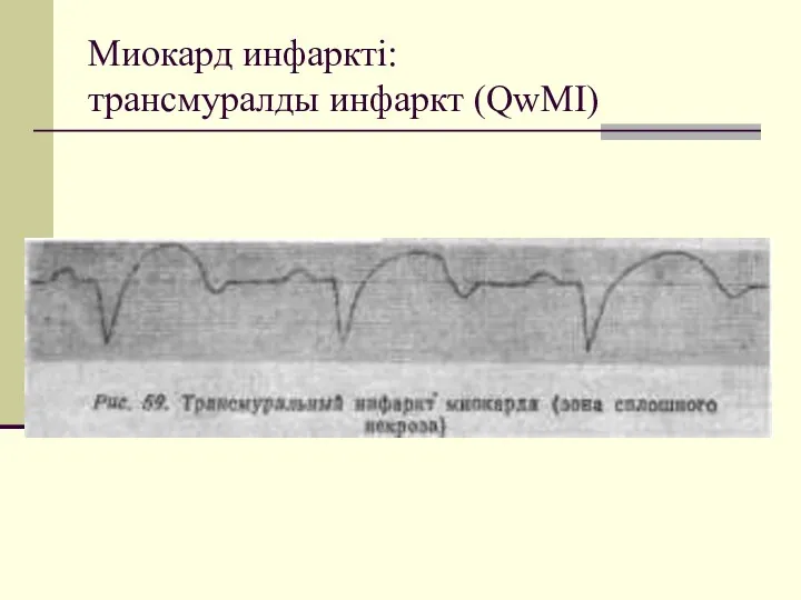 Миокард инфаркті: трансмуралды инфаркт (QwMI)