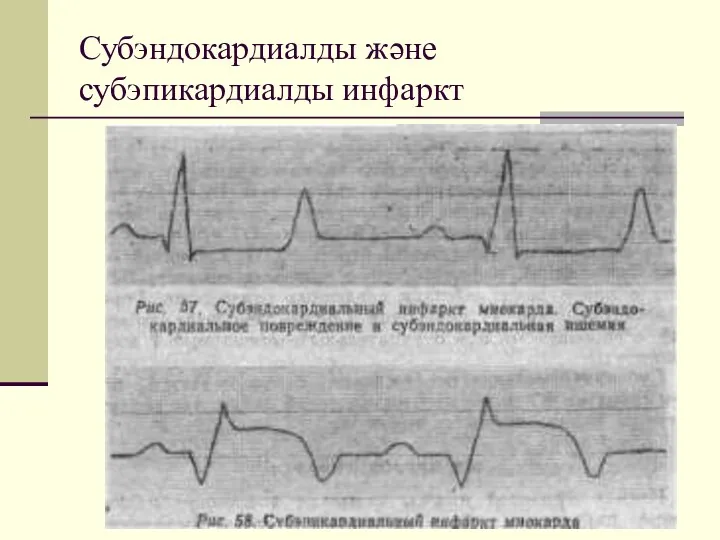 Субэндокардиалды және субэпикардиалды инфаркт