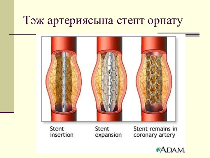 Тәж артериясына стент орнату