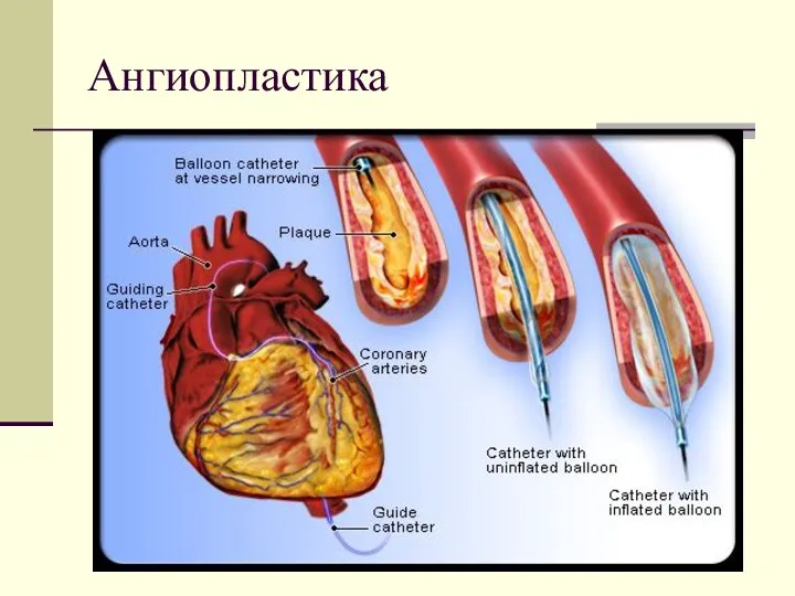 Ангиопластика