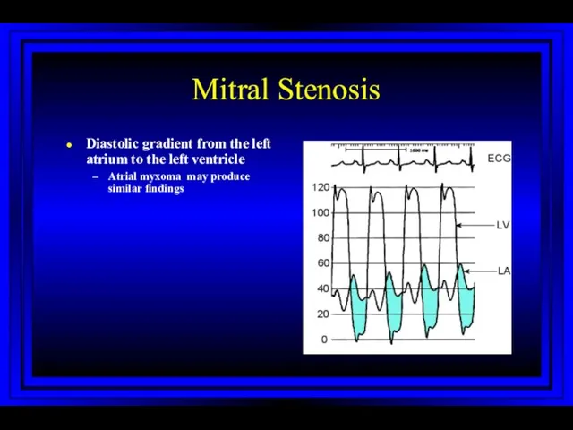 Mitral Stenosis Diastolic gradient from the left atrium to the