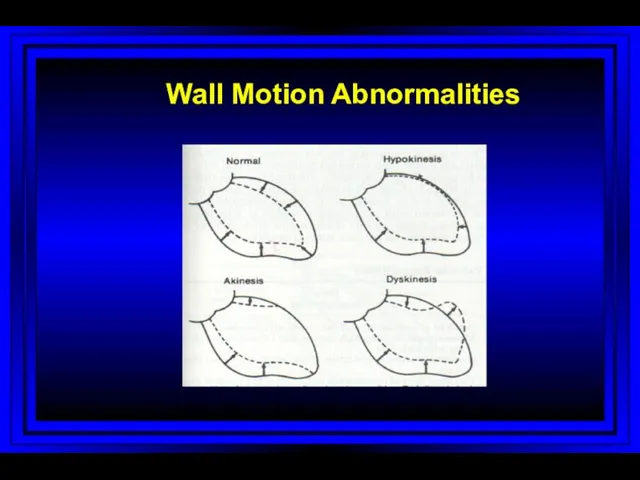 Wall Motion Abnormalities