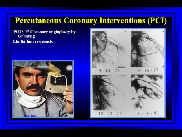 Percutaneous Coronary Interventions (PCI) 1977: 1st Coronary angioplasty by Gruntzig Limitation: restenosis 1939-1985