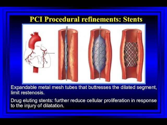 PCI Procedural refinements: Stents Expandable metal mesh tubes that buttresses
