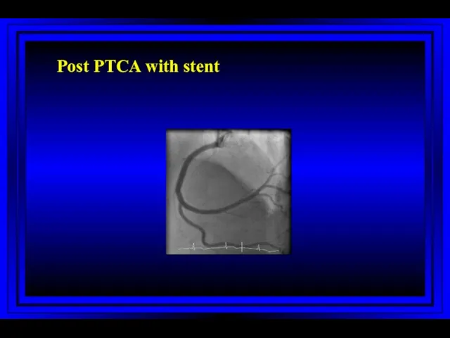 Post PTCA with stent