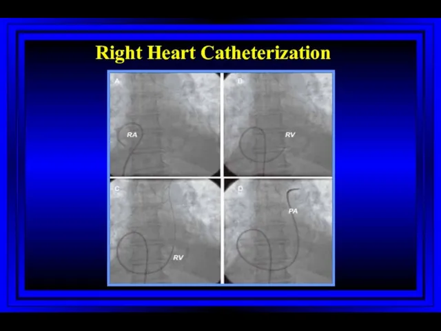 Right Heart Catheterization