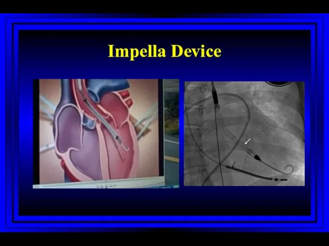 Impella Device