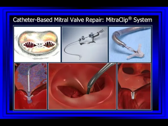 Catheter-Based Mitral Valve Repair: MitraClip® System