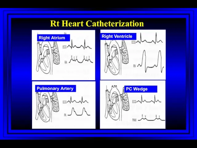 Right Atrium Right Ventricle Pulmonary Artery PC Wedge Rt Heart Catheterization