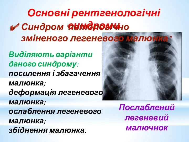 Основні рентгенологічні синдроми Послаблений легеневий малючнок Синдром "патологічно зміненого легеневого