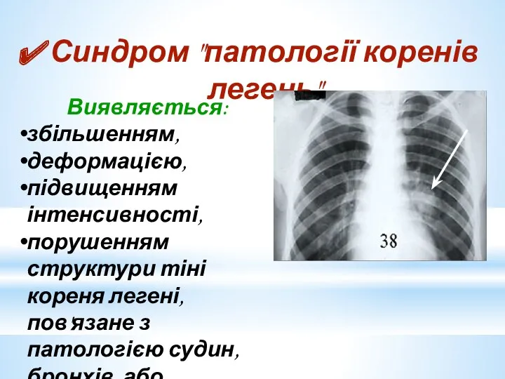 Синдром "патології коренів легень" Виявляється: збільшенням, деформацією, підвищенням інтенсивності, порушенням