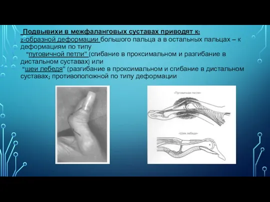 Подвывихи в межфаланговых суставах приводят к: z-образной деформации большого пальца