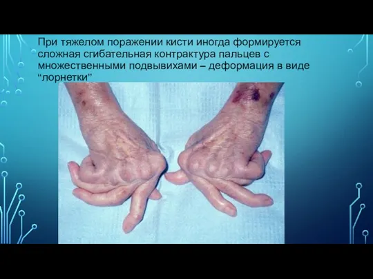 При тяжелом поражении кисти иногда формируется сложная сгибательная контрактура пальцев