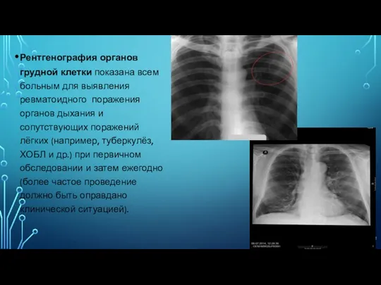 Рентгенография органов грудной клетки показана всем больным для выявления ревматоидного