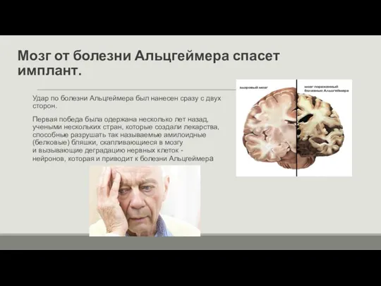 Мозг от болезни Альцгеймера спасет имплант. Удар по болезни Альцгеймера