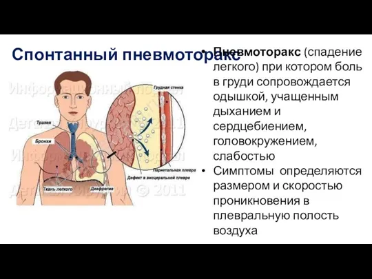 Спонтанный пневмоторакс Пневмоторакс (спадение легкого) при котором боль в груди