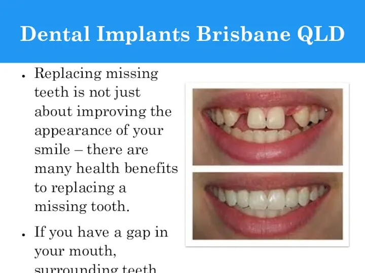 Dental Implants Brisbane QLD Replacing missing teeth is not just