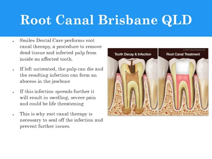 Root Canal Brisbane QLD Smiles Dental Care performs root canal