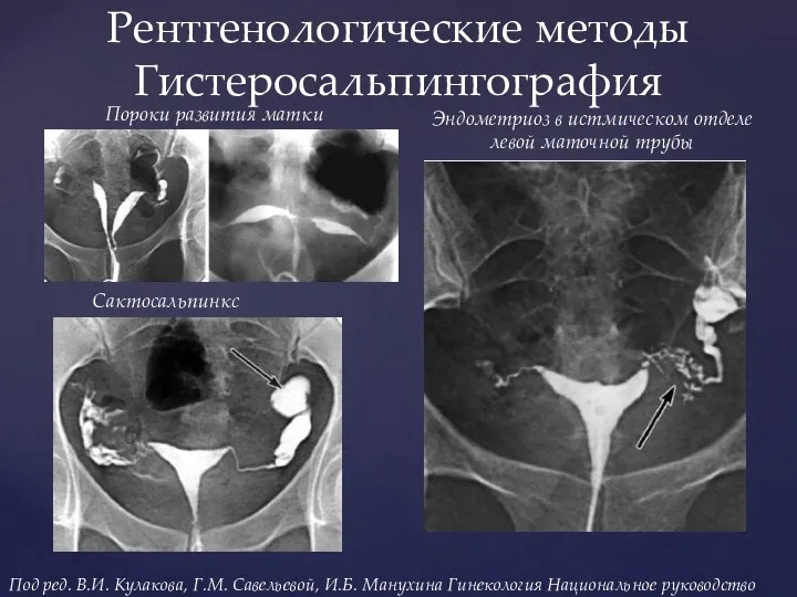 Рентгенологические методы Гистеросальпингография Пороки развития матки Сактосальпинкс Эндометриоз в истмическом отделе левой маточной