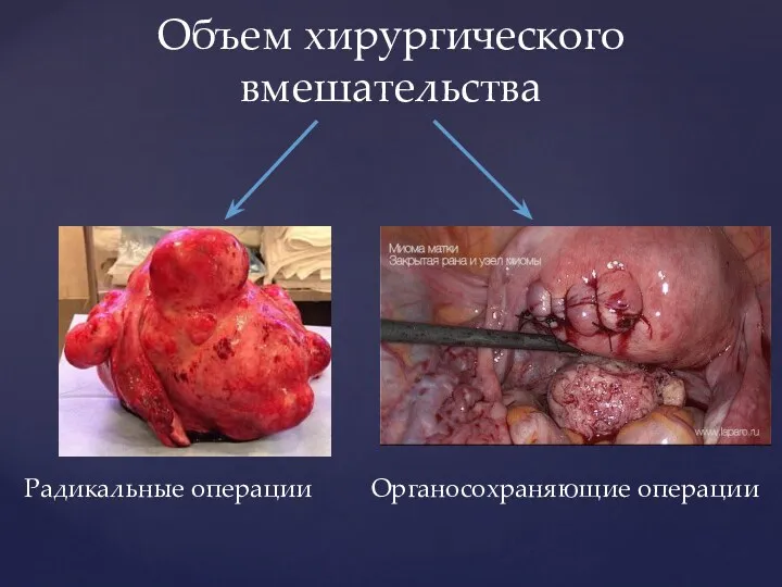 Объем хирургического вмешательства Радикальные операции Органосохраняющие операции