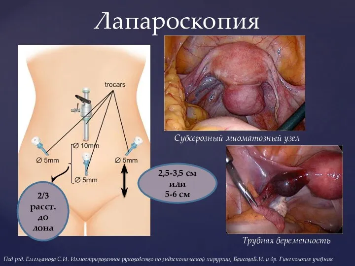 Лапароскопия 2,5-3,5 см или 5-6 см 2/3 расст. до лона Субсерозный миоматозный узел