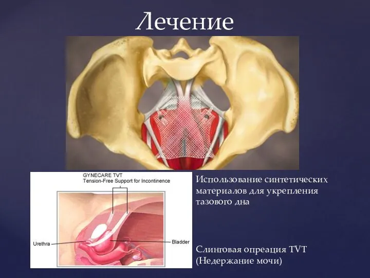 Лечение Слинговая опреация TVT (Недержание мочи) Использование синтетических материалов для укрепления тазового дна