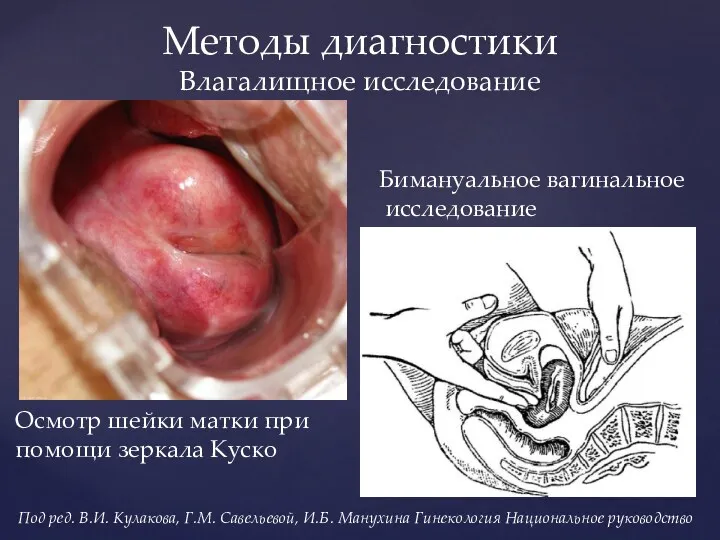 Методы диагностики Влагалищное исследование Осмотр шейки матки при помощи зеркала Куско Бимануальное вагинальное