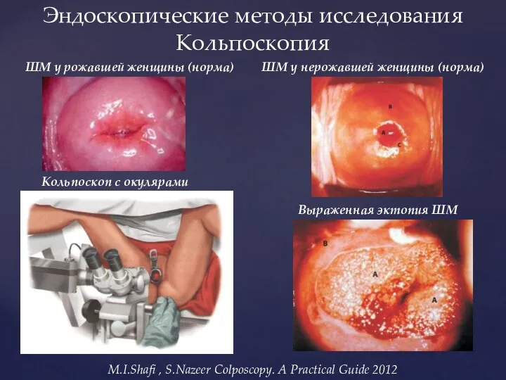 Эндоскопические методы исследования Кольпоскопия Кольпоскоп с окулярами ШМ у нерожавшей