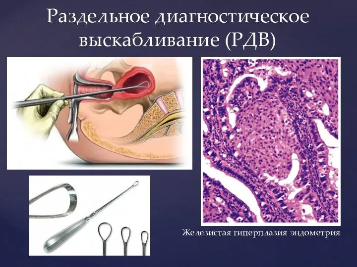 Раздельное диагностическое выскабливание (РДВ) Железистая гиперплазия эндометрия