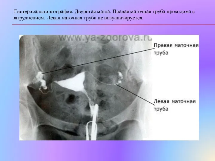 Гистеросальпингография. Двурогая матка. Правая маточная труба проходима с затруднением. Левая маточная труба не визуализируется.