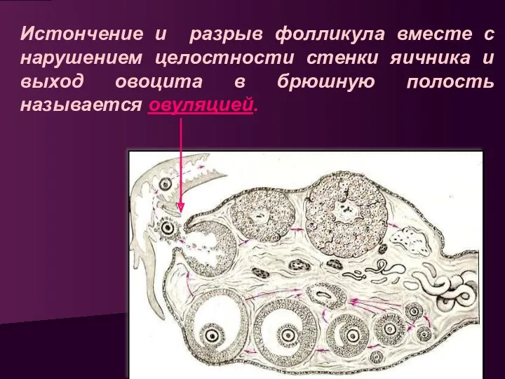 Истончение и разрыв фолликула вместе с нарушением целостности стенки яичника