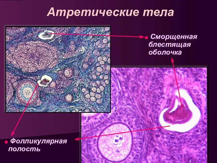 Атретические тела Сморщенная блестящая оболочка Фолликулярная полость