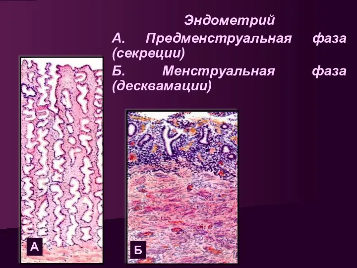 Эндометрий А. Предменструальная фаза (секреции) Б. Менструальная фаза (десквамации) А Б