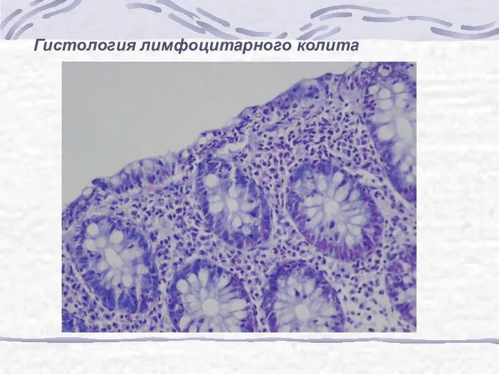 Гистология лимфоцитарного колита