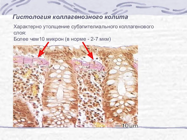 Характерно утолщение субэпителиального коллагенового слоя: Более чем10 микрон (в норме - 2-7 мкм) Гистология коллагенозного колита