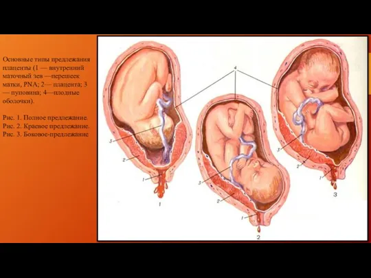 Основные типы предлежания плаценты (1 — внутренний маточный зев —перешеек матки, PNA; 2—