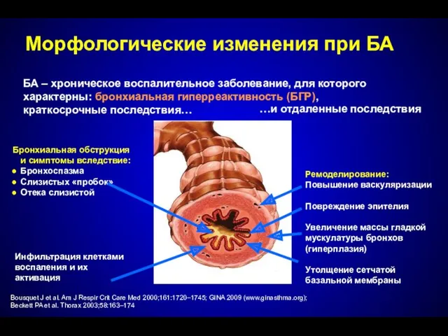 Морфологические изменения при БА БА – хроническое воспалительное заболевание, для