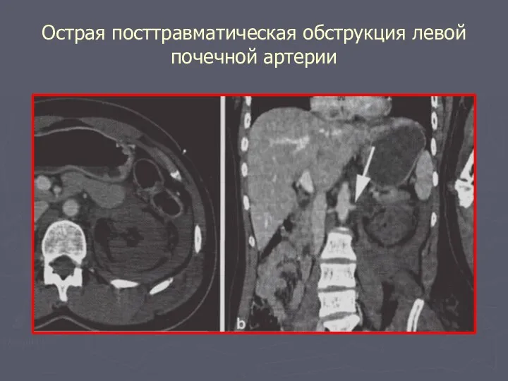 Острая посттравматическая обструкция левой почечной артерии