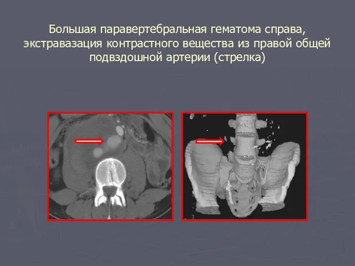 Большая паравертебральная гематома справа, экстравазация контрастного вещества из правой общей подвздошной артерии (стрелка)