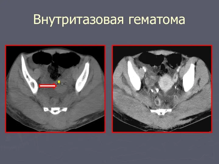 Внутритазовая гематома